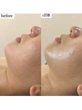 アエ メゾン(ae maison)/【施術1回】フェイスライン