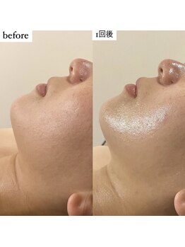 アエ メゾン(ae maison)/【施術1回】フェイスライン