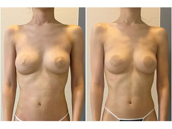 モア(moa)/肋骨ぱっかーんもこの通り！