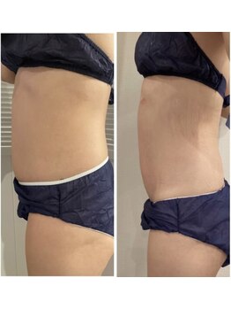 ココカラ(COCOKARA)/脂肪冷却/脂肪分解剤導入