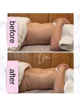 ルミライズヴィブリス(lumirise vibliss)/30代 腸もみ＋小顔矯正