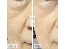 グリーンノート(GREEN NOTE)/ヒト臍帯血細胞培養液65％