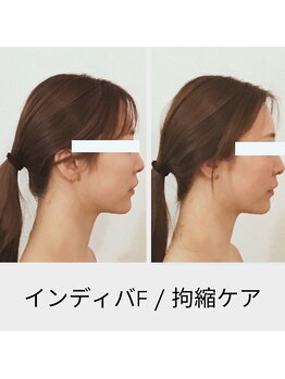 リムビューティー 自由が丘(RymBeauty)/インディバ 拘縮ケア