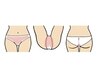 ホットペッパー限定☆ VIOミックス脱毛（VIOワックス脱毛＋光脱毛）