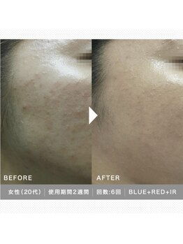 ティアーナ(Tiaana)/LED　６回