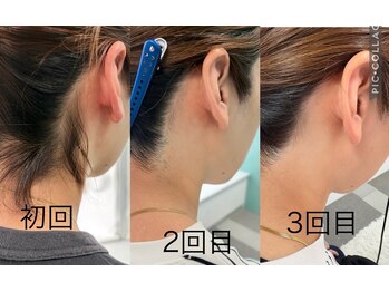 カピリナ(kapilina)/うなじ脱毛