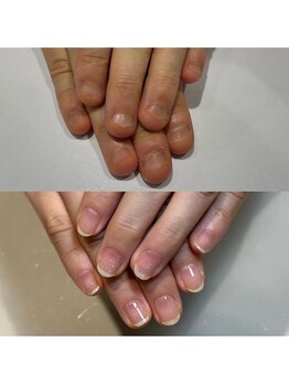 ティアラネイル 宇都宮/深爪矯正