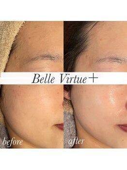 ベルバーチュプラス(Belle Virtue +)/カーボキシー