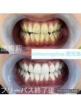 ホワイトニングショップ 鹿児島店/#鹿児島ホワイトニング