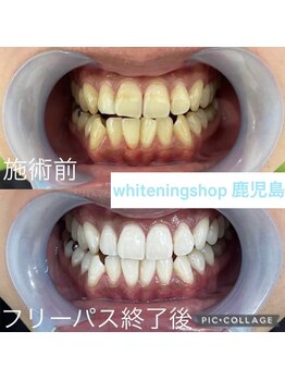 ホワイトニングショップ 鹿児島店/#鹿児島ホワイトニング