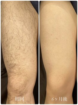 クーレ(CURE)/脚脱毛で短パンも綺麗に履ける♪