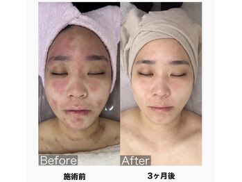 アルゴ 吹田千里山駅前店(ALGO)/造顔メソッド~B/A~