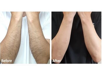 フィールフリー(Feel Free)/腕のビフォーアフター