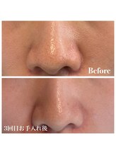 ピュア 川越店/光＋毛穴洗浄＋生マスク