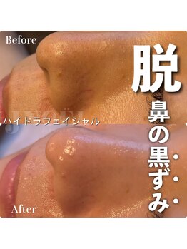 ジェノール 2nd beauty studio 姫路駅前店(JNOEL)/毛穴お悩みゴッソリ解消