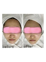 エクスクラメーションマーク(!!!)/超音波リフトアップ