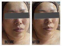 ザ ワン(THE ONE)/徹底的に美肌に！幹細胞導入