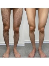 ロイビー(loeyB)/2回照射して１ヶ月後です