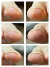巻き爪ケアもお任せください！