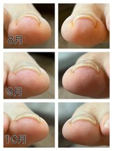 キャンディベース ドライブイン(Candybase Drive in)/巻き爪ケアもお任せください！