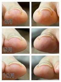 巻き爪ケアもお任せください！