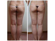 リセル(Re-Cell)の雰囲気(年々増えてくセルは、施術で出してくことで大幅減少可能!)