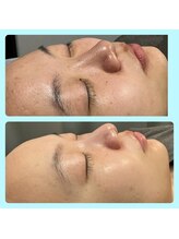 シャラクアクティ(sharaku acty)/肌質改善