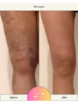 リサプリ(Re: Supple)/美容施術後の回復力UP!