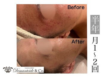 デマントイド 倉敷(Demantoide&Co)/メンズフェイシャル