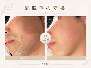 ビビ(bibi)/メンズヒゲ脱毛施術12回