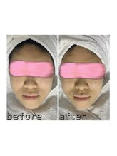 エクスクラメーションマーク(!!!)/超音波リフトアップ