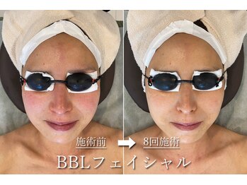 ギンレイ(GINREI)/ 【Before → After】