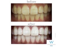 ホワイトニングショップ 新潟店/ホワイトニングビフォーアフター