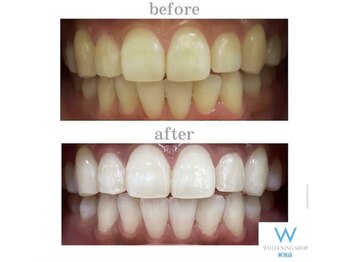 ホワイトニングショップ 新潟店/ホワイトニングビフォーアフター