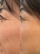 長寿鍼灸院 長寿整骨院/美容鍼50本の効果★目じりの弾力