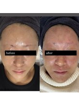 アズリー ルナ(AzRee Luna)/レストセルトリートメント