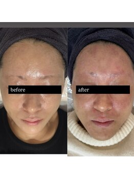 アズリー ルナ(AzRee Luna)/レストセルトリートメント