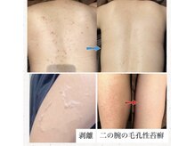 ジュエリーボディー(Jewelry body)の雰囲気（鹿児島初！ボディのハーブピーリング 1部位9,000円！！）