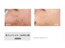 サロン ルアナ(salon luana)/光フェイシャル　before→after