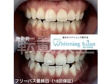 ホワイトニングサロン 福岡天神店/ホワイトニング