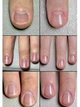 ライクネイル 本店(RaiK NaiL)/深爪改善ビフォーアフター