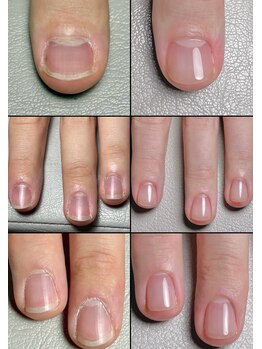 ライクネイル 本店(RaiK NaiL)/深爪改善ビフォーアフター