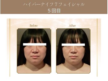 漢方アロマヒーリングサロン 浦和店(漢方AROMAヒーリングサロン)/ハイパーナイフ7★フェイシャル
