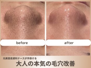 サンゴ(Sango)の写真/夏に気になる毛穴に◎キュッと引き締め、黒ずみ改善！ストレスフリーな自信の持てる素肌へ♪満足度No1★