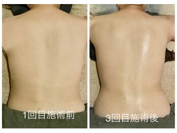 サロン ド サッコ(salon de sacco)/【3回終了後】ビフォーアフター