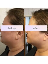 小顔革命 小顔 全身美容矯正専門店/二重顎フェイスライン特化コース