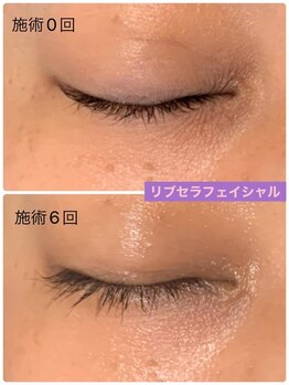 プリュネル(Prunelle)/プラズマシャワー