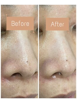 FJ/驚きの即効性◆黒ずみ毛穴ケア