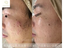 サロン ド レナ(Salon de LENA)/ハーブピーリング サロンドレナ