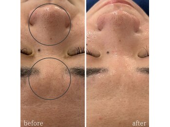 ニコリー(NICOLY)/角栓毛穴洗浄フェイシャル